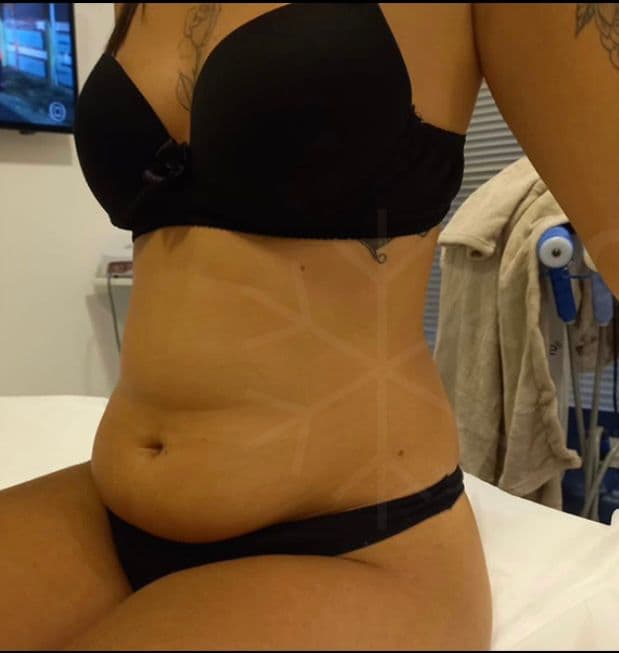 Resultado antes - Protocolo CrioLipo