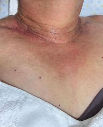 Resultado antes - Tratamento Flacidez