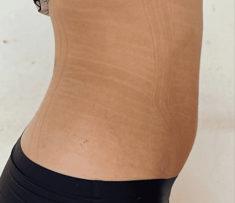 Resultado depois - Protocolo CrioLipo