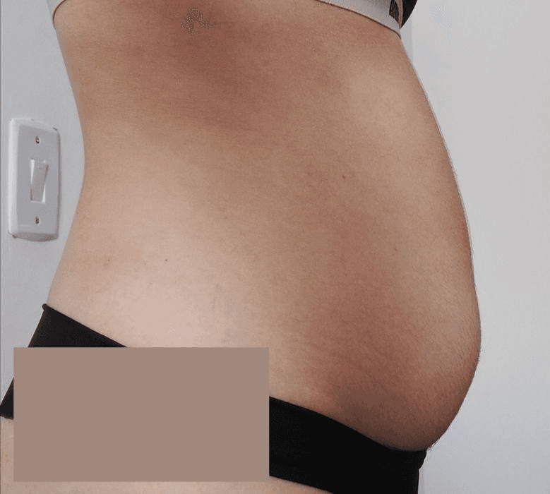 Resultado antes - Protocolo CrioLipo