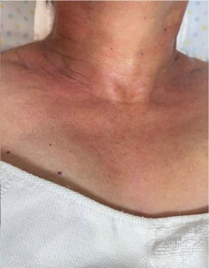 Resultado depois - Tratamento Flacidez