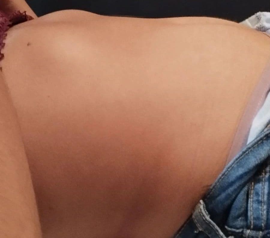 Resultado antes - Massagem Modeladora