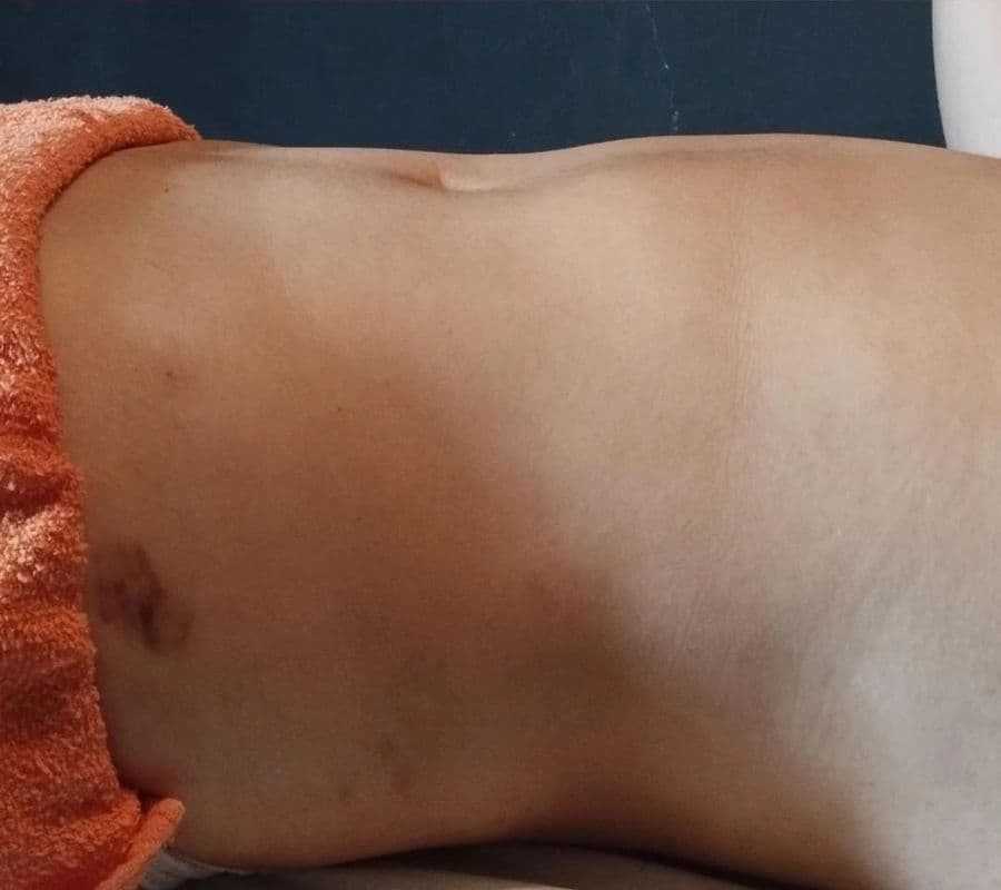 Resultado antes - Massagem Modeladora