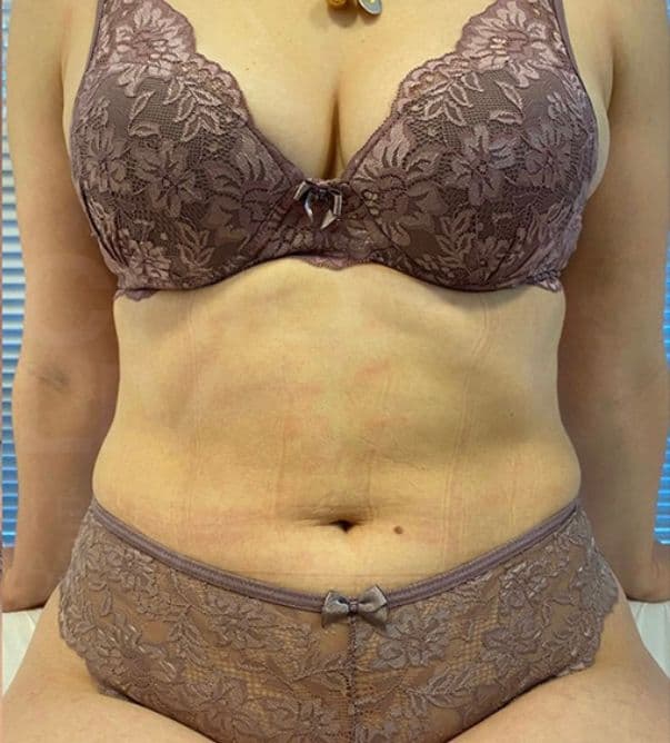 Resultado depois - Protocolo CrioLipo