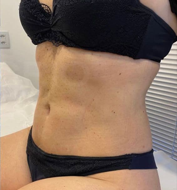 Resultado depois - Protocolo CrioLipo