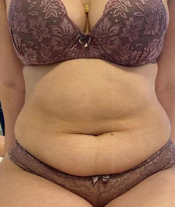 Resultado antes - Protocolo CrioLipo