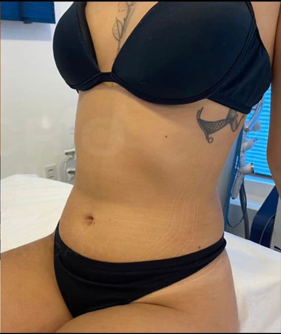 Resultado depois - Protocolo CrioLipo