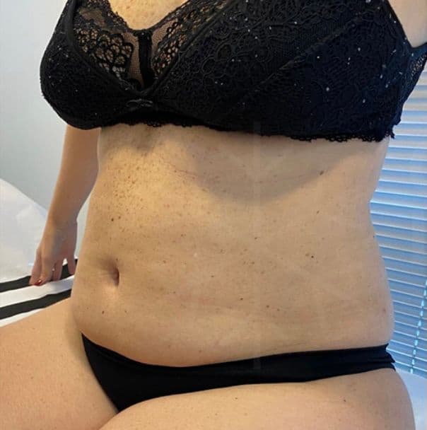 Resultado antes - Protocolo CrioLipo